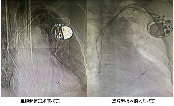 【医心“卫”您】从“单声道”到“立体声” 、单腔到双腔——起搏器的华丽蜕变