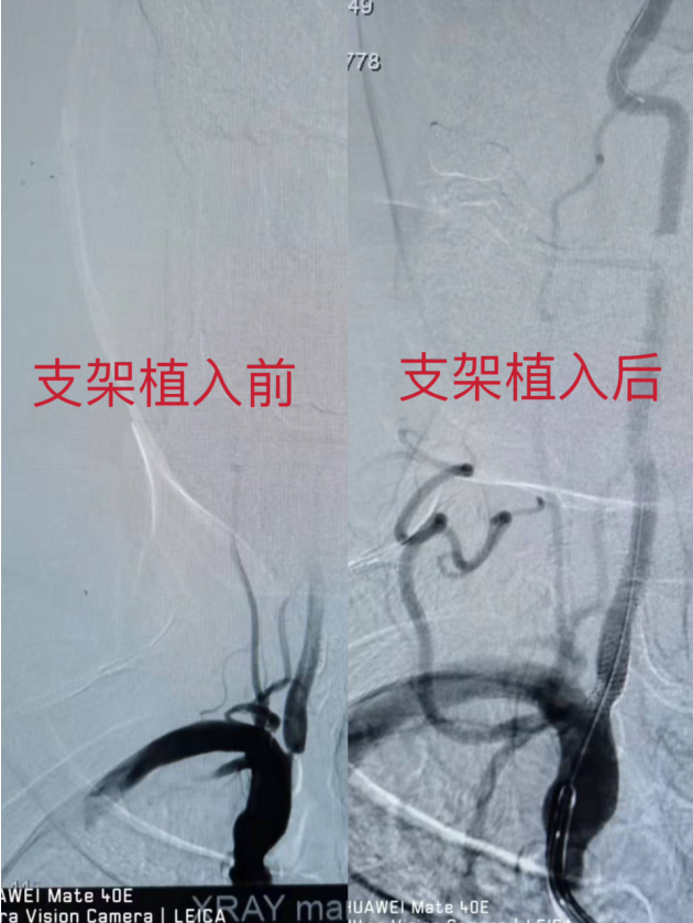 重焕椎动脉通畅，开启健康新征程——椎动脉支架植入术