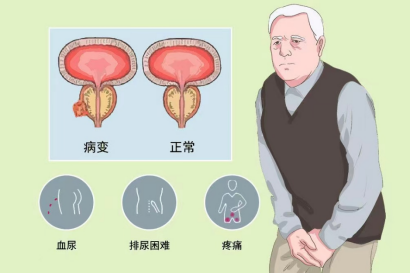 免费筛查 ：关爱生命“腺” ， 前列腺癌早期筛查义诊活动