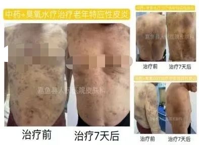 【皮肤科】看病就在“嘉”里面 十年皮肤顽疾“泡”好了