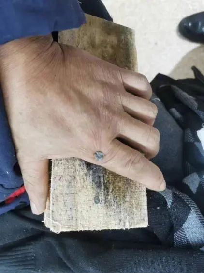 钢钉意外贯穿手指，骨二科医生安全取出！