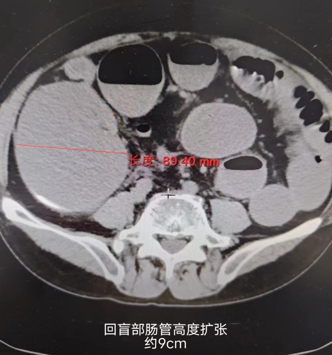 医患同心 共克时艰丨我院普外科再添锦旗