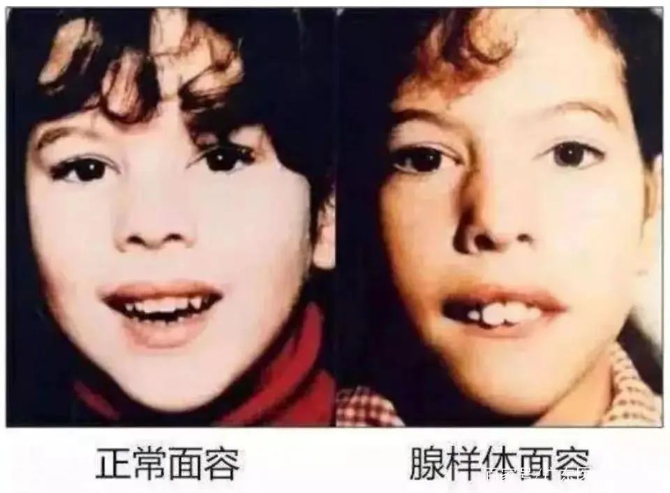 扁桃体、腺样体对儿童有什么影响？专家替你解答！